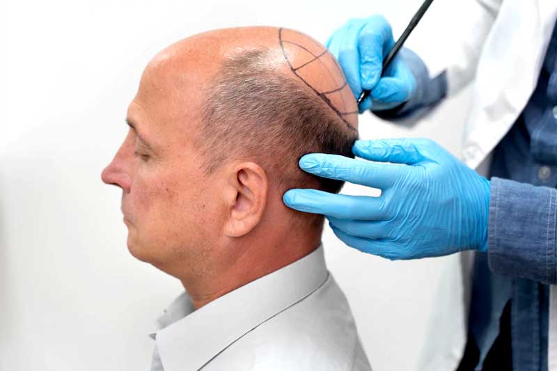 Hair transplantation Antalya